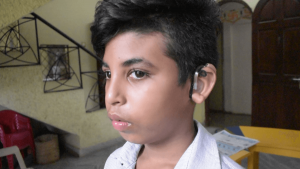 Purchase of Cochlear Implant