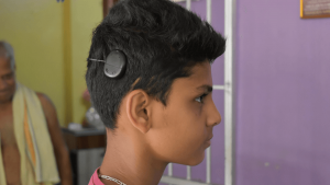 Purchase of Cochlear Implant